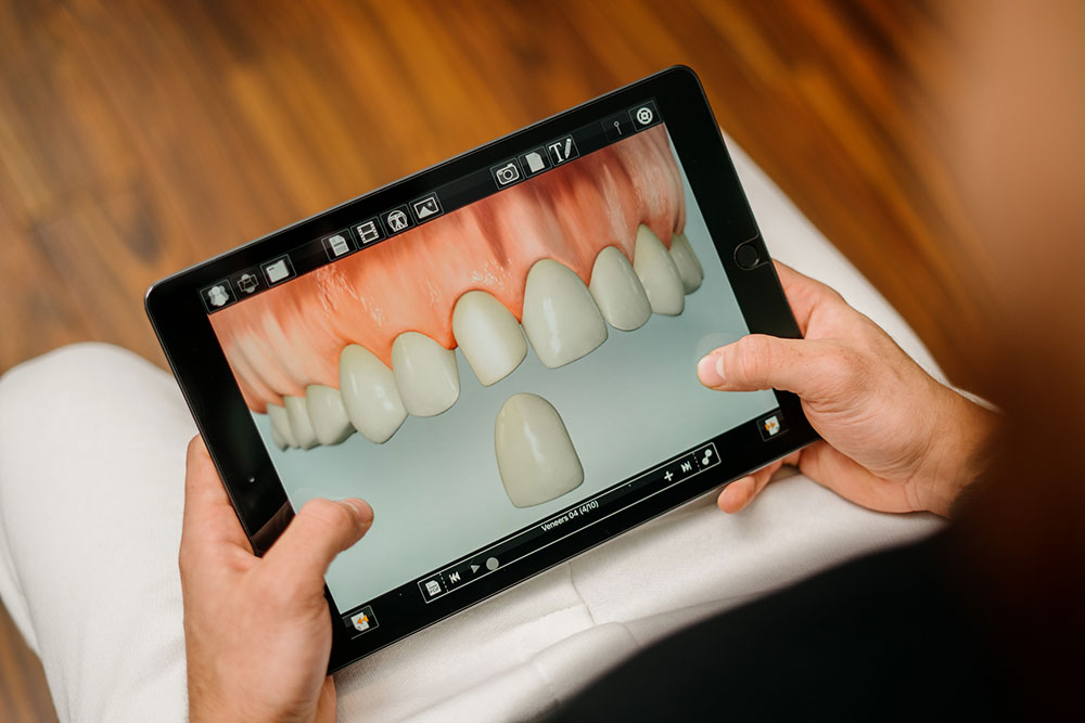 Veneers - kleine Zahnfehler korrigieren. Ästhethische Zahnmedizin München